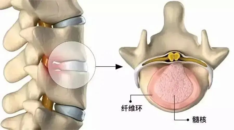 椎间盘突出