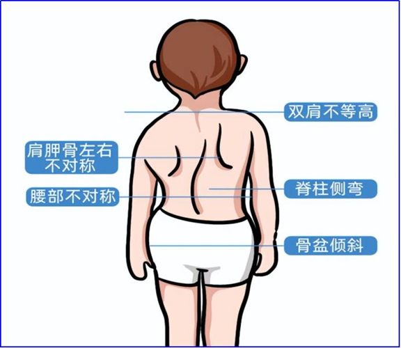 脊柱侧弯外观特征