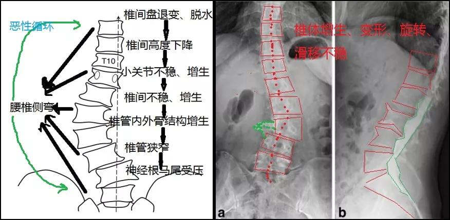 腰椎侧弯