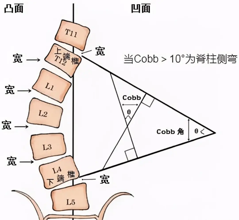 cobb角测量方法