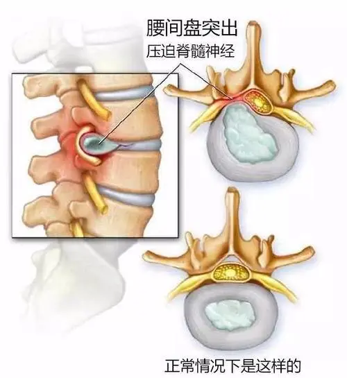 腰椎间盘突出压迫脊髓神经