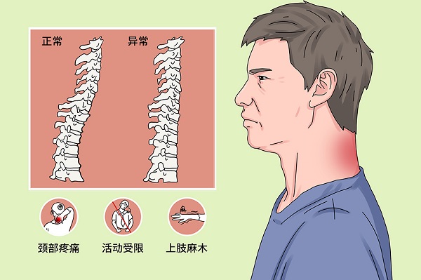 颈椎曲度变直危害