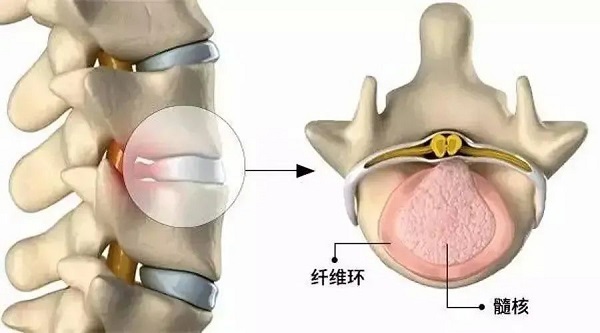 腰椎间盘突出
