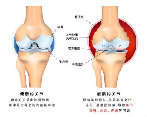 关节对比图