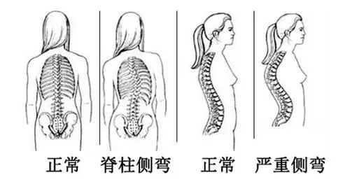 正常脊柱与脊柱病变对比图