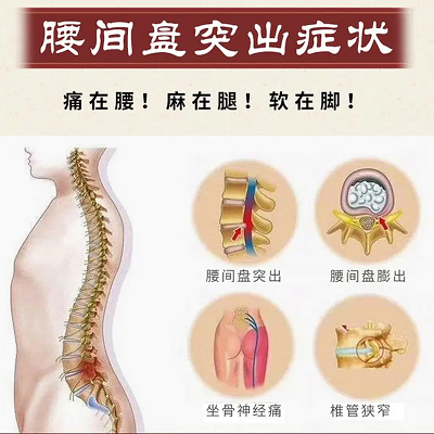 腰椎间盘突出症状