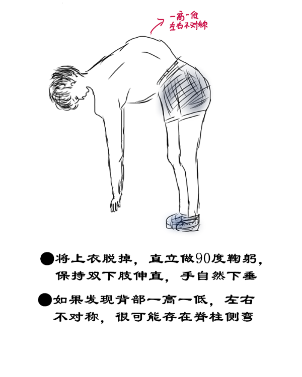 脊柱侧弯自查方法